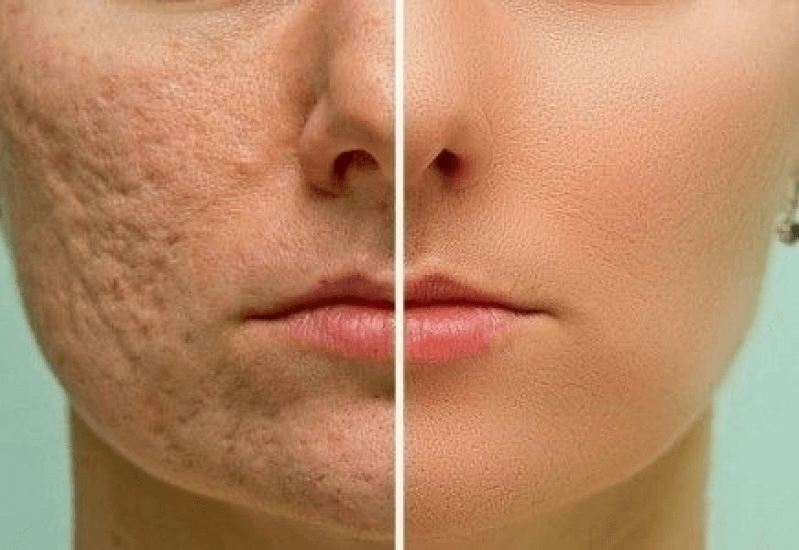 beneficios ozonioterapia tratamento da pele